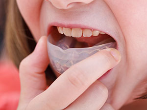 口腔歯列誘導装置（マイオブレース）とは？