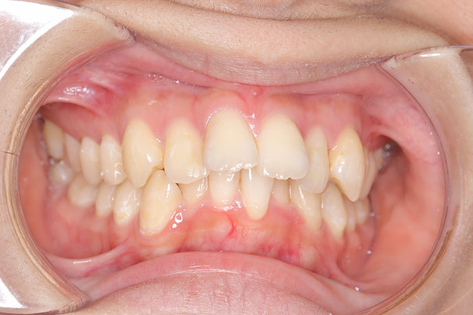 上顎前突、上下顎前歯叢生、過蓋咬合 治療前1