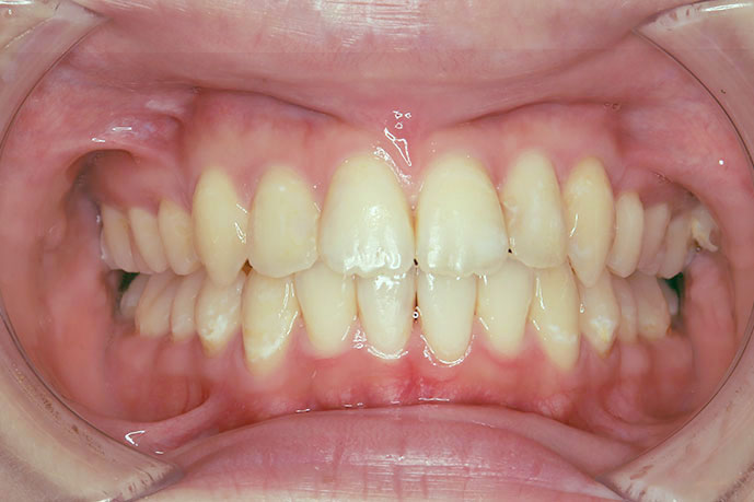 上顎前突、上下顎前歯叢生、過蓋咬合 治療後1