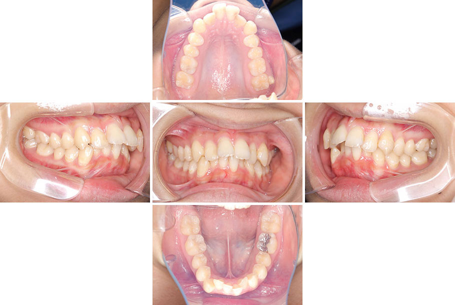 上顎前突、上下顎前歯叢生、過蓋咬合 治療前2