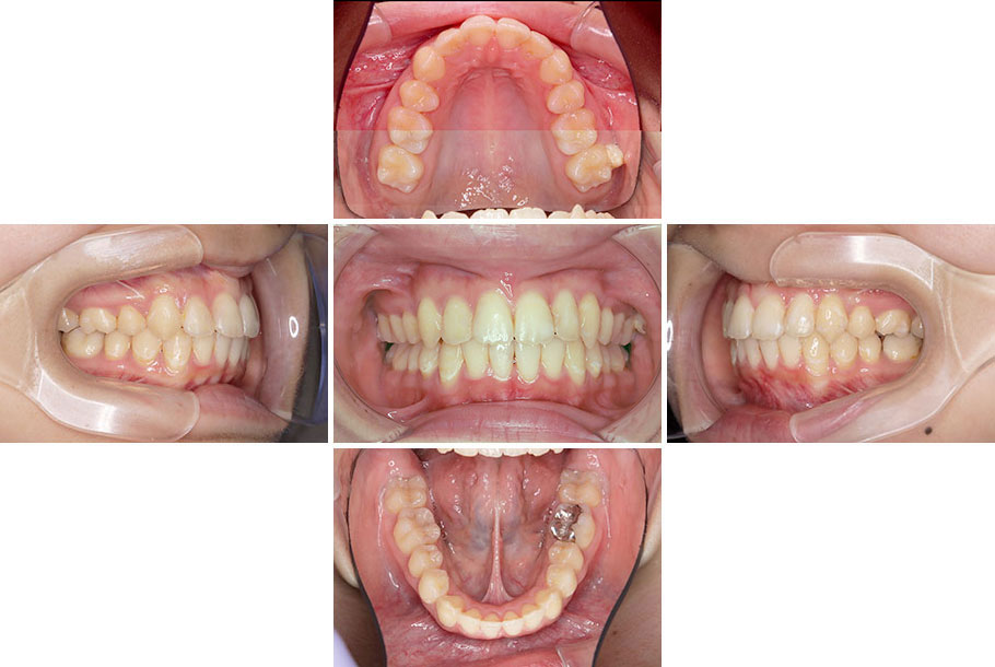 上顎前突、上下顎前歯叢生、過蓋咬合 治療後2