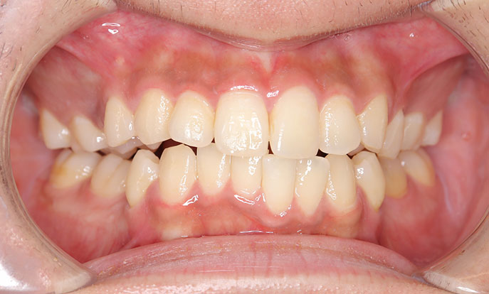 開咬（前歯が噛み合わない）症例2、治療前1