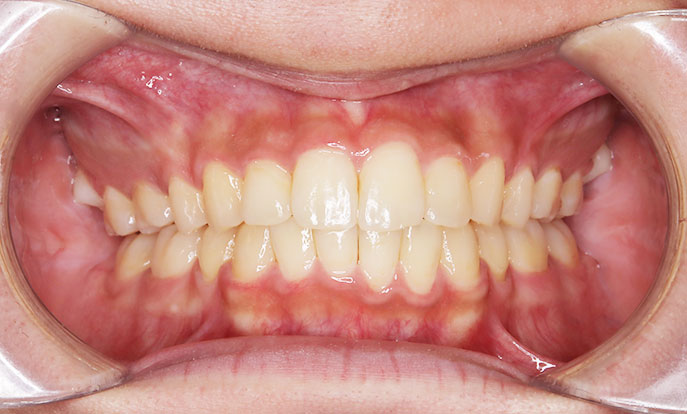 開咬（前歯が噛み合わない）症例2、治療後1