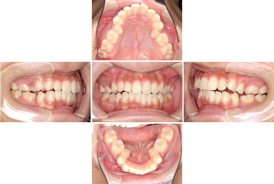 開咬（前歯が噛み合わない）症例2、治療前2