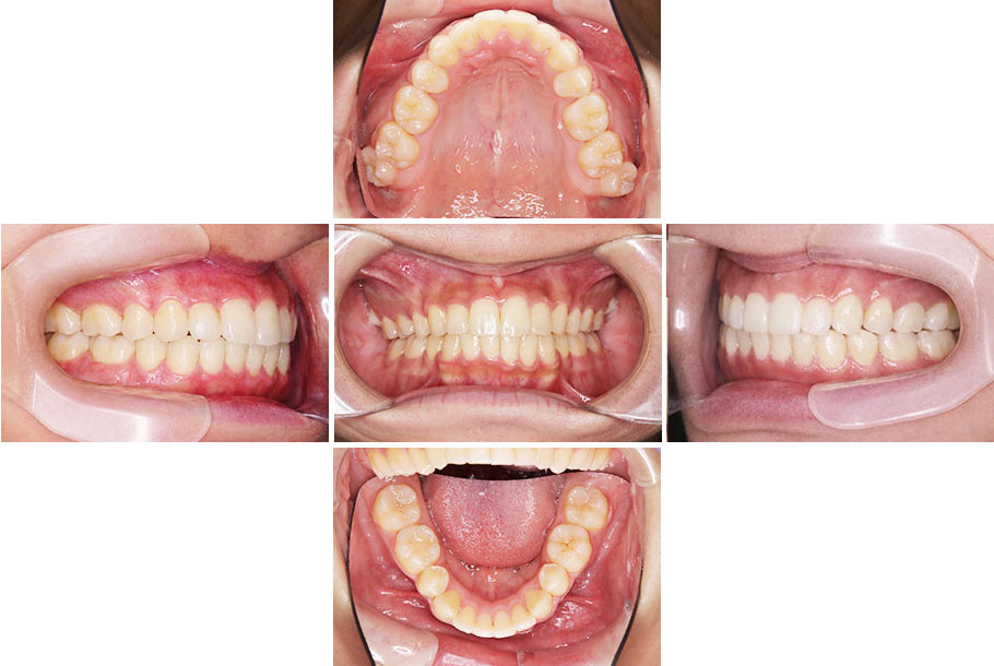 開咬（前歯が噛み合わない）症例2、治療後2