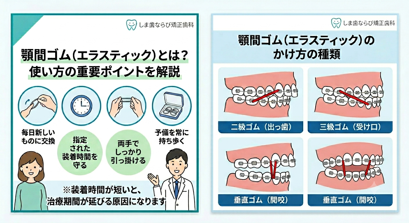 顎間ゴム(エラスティック)のイメージ|矯正治療中のゴムかけ説明